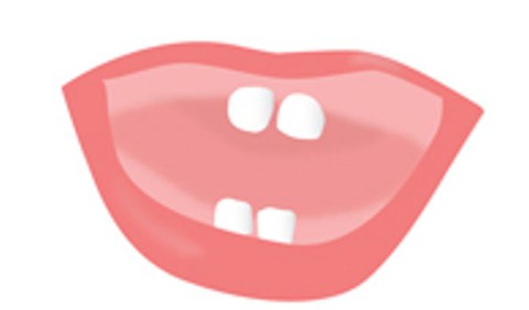 Illustration av en barnmun med fyra tänder